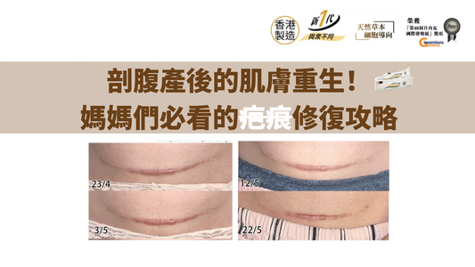 剖腹產後的肌膚重生！媽媽們必看的疤痕修復攻略